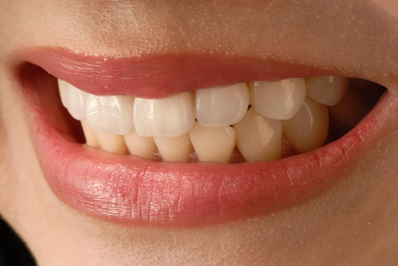asian smile, anterior teeth, veneer, porcelain veneer, lip, beauty, veneer, veneer, veneer, veneer, veneer. Affordable veneers ads: photos are not treatment plans